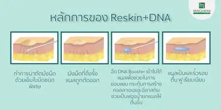 หลักการ รักษา Reskin DNA