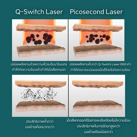 พิโคเลเซอร์ pico Qs-switch laser