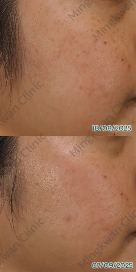 รีวิว Pico toning