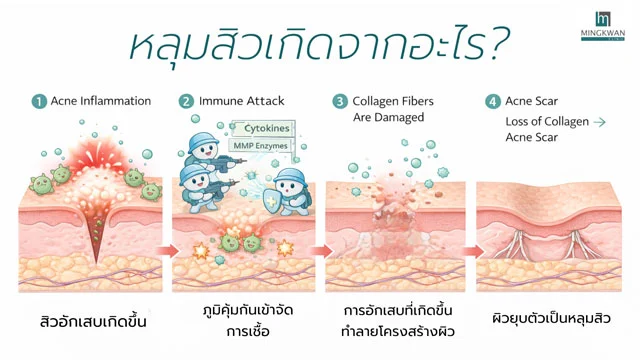 หลุมสิว เกิดจาก อะไร