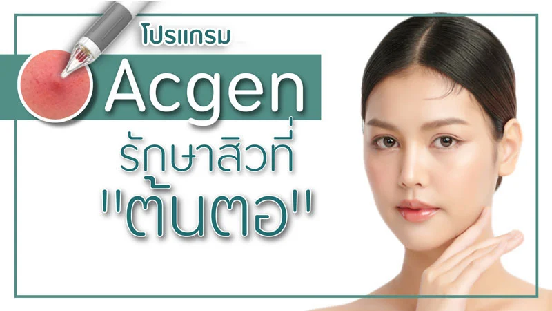 acgen แอกเจน รักษา สิว