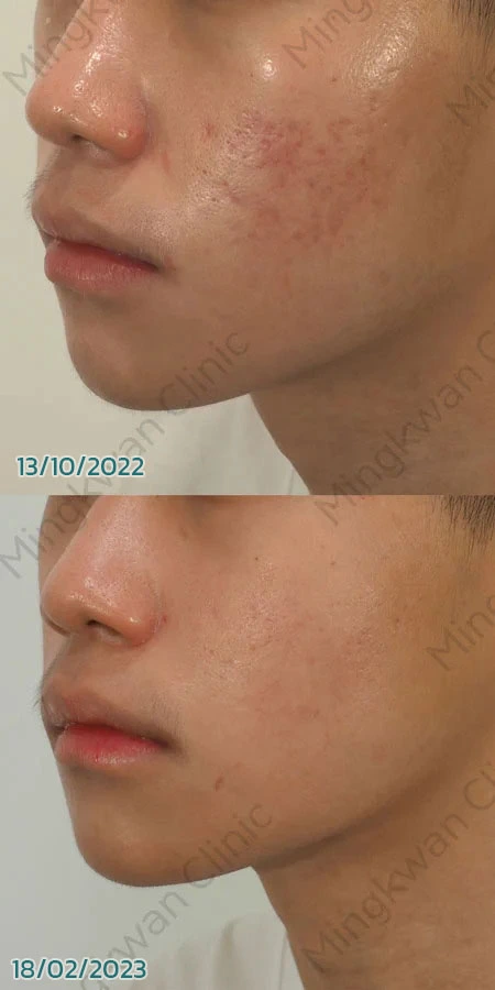 Fractional CO2 Laser For Acne Scars Mingkwan Clinic Bangkok 