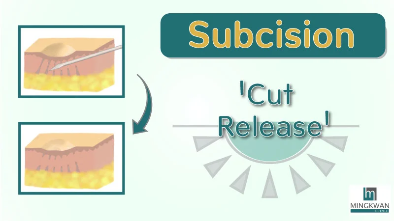 subcision